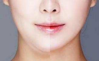 杭州微創(chuàng)額頭紋手術醫(yī)生