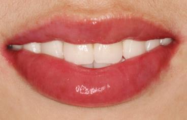 長(zhǎng)春矯正乳頭肥大醫(yī)生