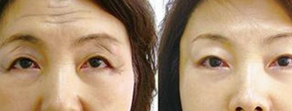 廣州玻尿酸填充上眼瞼醫(yī)生