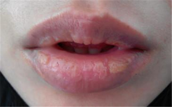 深圳狼毒斑醫(yī)生