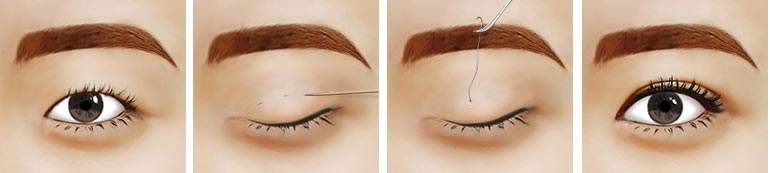 2023年天津公立醫(yī)院雙眼皮手術(shù)排名及網(wǎng)友好評(píng)！