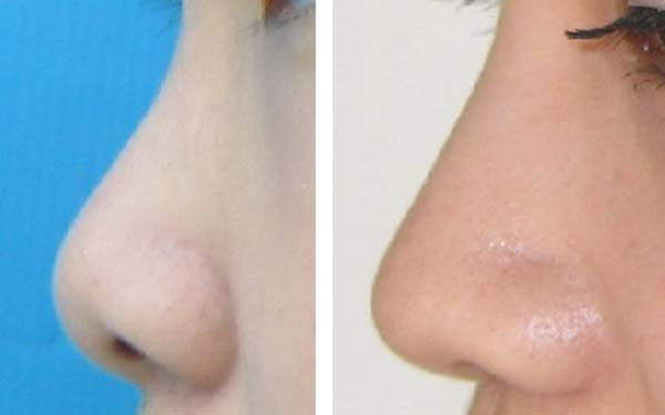 珠海眼上魚尾紋醫(yī)生