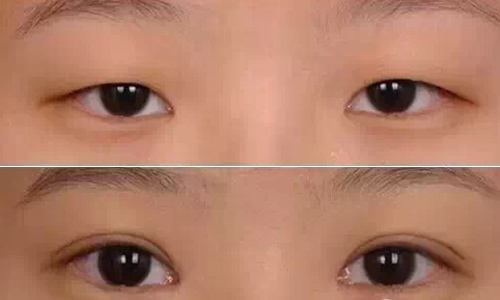 阜新點(diǎn)陣祛川字紋醫(yī)生