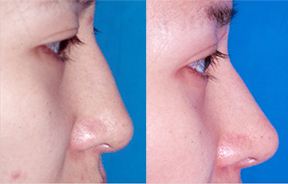 上海優(yōu)秀顴骨內(nèi)推機構(gòu)排行榜發(fā)布！美聯(lián)臣、仁愛上榜！尋找最佳整形報價指南