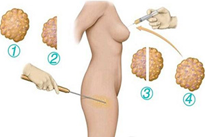 上海九院：網(wǎng)友推薦的面部吸脂醫(yī)生前五名曝光！