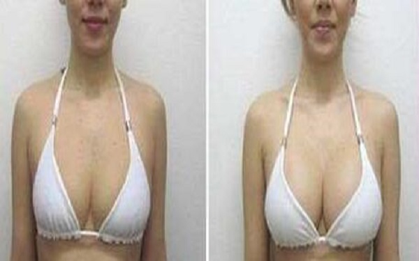 東莞最佳度膨體隆鼻醫(yī)院匯總：華美、維多利亞、禾美、知美脫穎而出！讓你一探究竟！