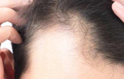 【溫州整形醫(yī)院】哪種埋線雙眼皮更適合？芘麗芙與伯思立對(duì)比及過來人經(jīng)驗(yàn)分享