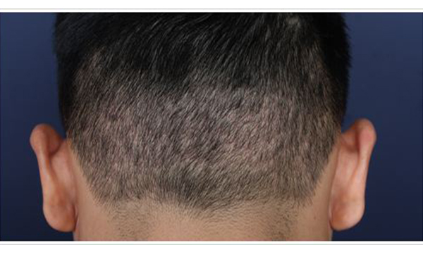 南京脫發(fā)治療中心評價(jià)匯總前四：擁有健康華麗的秀發(fā)，告別頭頂稀疏~