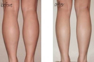 溫州脈沖強光去黃褐斑醫(yī)生