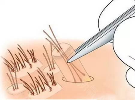 全國(guó)著名植發(fā)醫(yī)院排行榜！推薦您前往上海九院、新生等頂級(jí)機(jī)構(gòu)