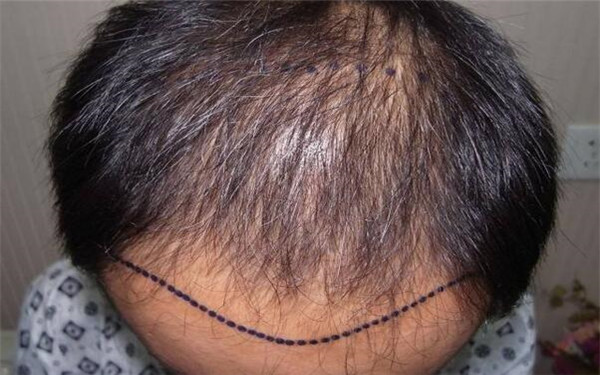 內(nèi)蒙古烏蘭浩特市最佳修復(fù)雙眼皮技術(shù)，誠(chéng)意推薦的專業(yè)醫(yī)療機(jī)構(gòu)排行榜