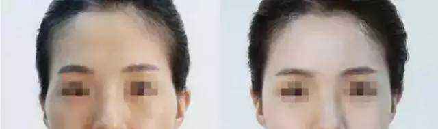 蘭州頂級整容醫(yī)院排行榜：讓你安心整形，保障你的雙眼皮手術(shù)結(jié)果！