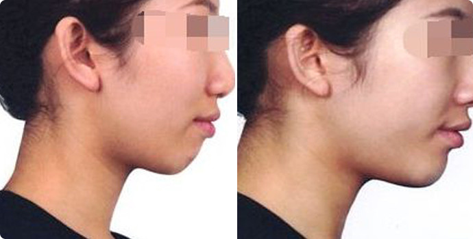 常州雙眼皮整形醫(yī)院精選六家頂級(jí)醫(yī)院，詳情提前公布！