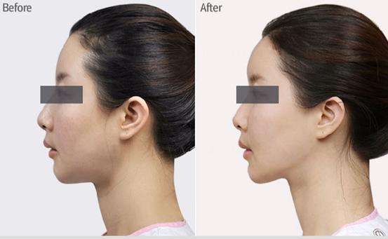 寧波哪家醫(yī)院的拉皮手術(shù)技術(shù)獨(dú)步全市？精選的前五醫(yī)院名單，藝星、薇琳等都上榜！