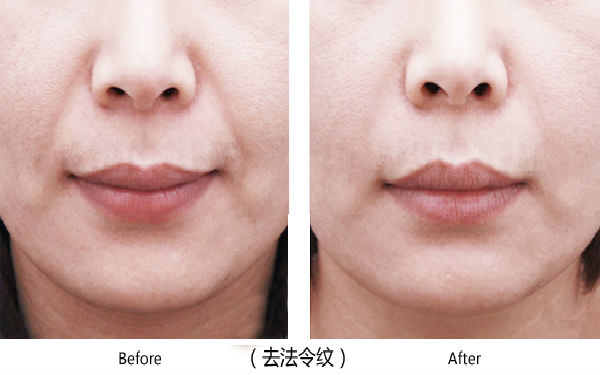 寶雞整容醫(yī)院大整頂級優(yōu)質匯總！高一生對決愛容妍_絕對實力的對比震撼