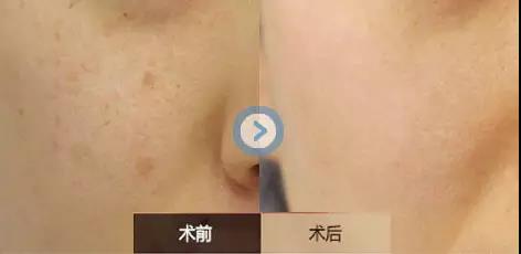 葫蘆島干細胞祛疤印醫(yī)生