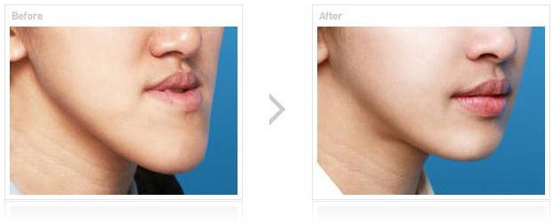 嘉興市最佳雙眼皮醫(yī)院評選揭曉！網友留言熱議翻墻！