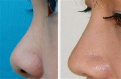 柳州背部激光溶脂醫(yī)生