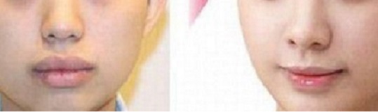 成都激光脂肪填充醫(yī)院推薦排行榜：軍大、華美、瑪麗亞奪冠！愛美者贊不絕口，美容圣地值得珍藏！