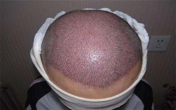 深圳祛除黑眼圈的五家整形醫(yī)院排名單公布！風格多樣，技術獨特！價目表內幕，助你選對醫(yī)院！