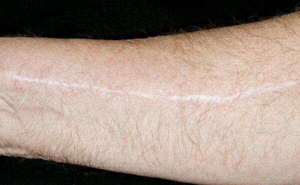 四川干細(xì)胞填充額頭紋醫(yī)生