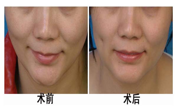 湖州雙眼皮手術(shù)機(jī)構(gòu)推薦：3家優(yōu)質(zhì)醫(yī)院完美整形，放心選擇