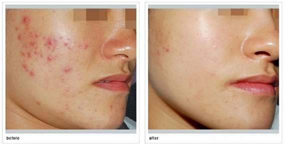 煙臺2023年最受青睞的割雙眼皮醫(yī)院：壹美天成、鵬愛、洛神、青韓、知顏排名TOP！