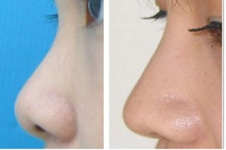 鞍山哪家醫(yī)院做雙眼皮整形效果一年復盤，專家評價出乎意料！齊敏與張玉霞功力對決！