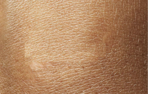 福州水光針祛除魚尾紋醫(yī)生