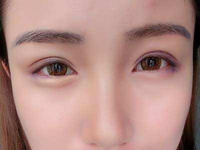 鄭州小切口去眼周紋醫(yī)生