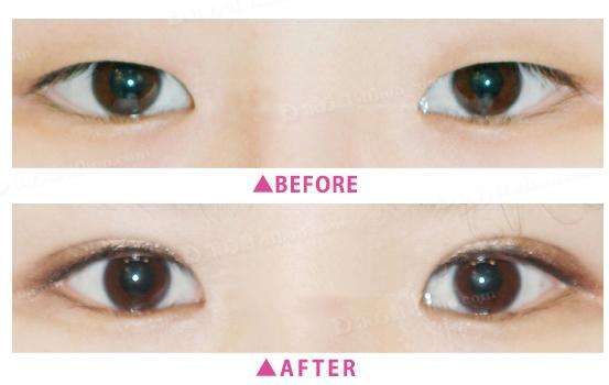 2023寧波眼瞼疤痕修復美容醫(yī)院排名揭曉！專業(yè)修復眼瞼疤痕的醫(yī)院在這！