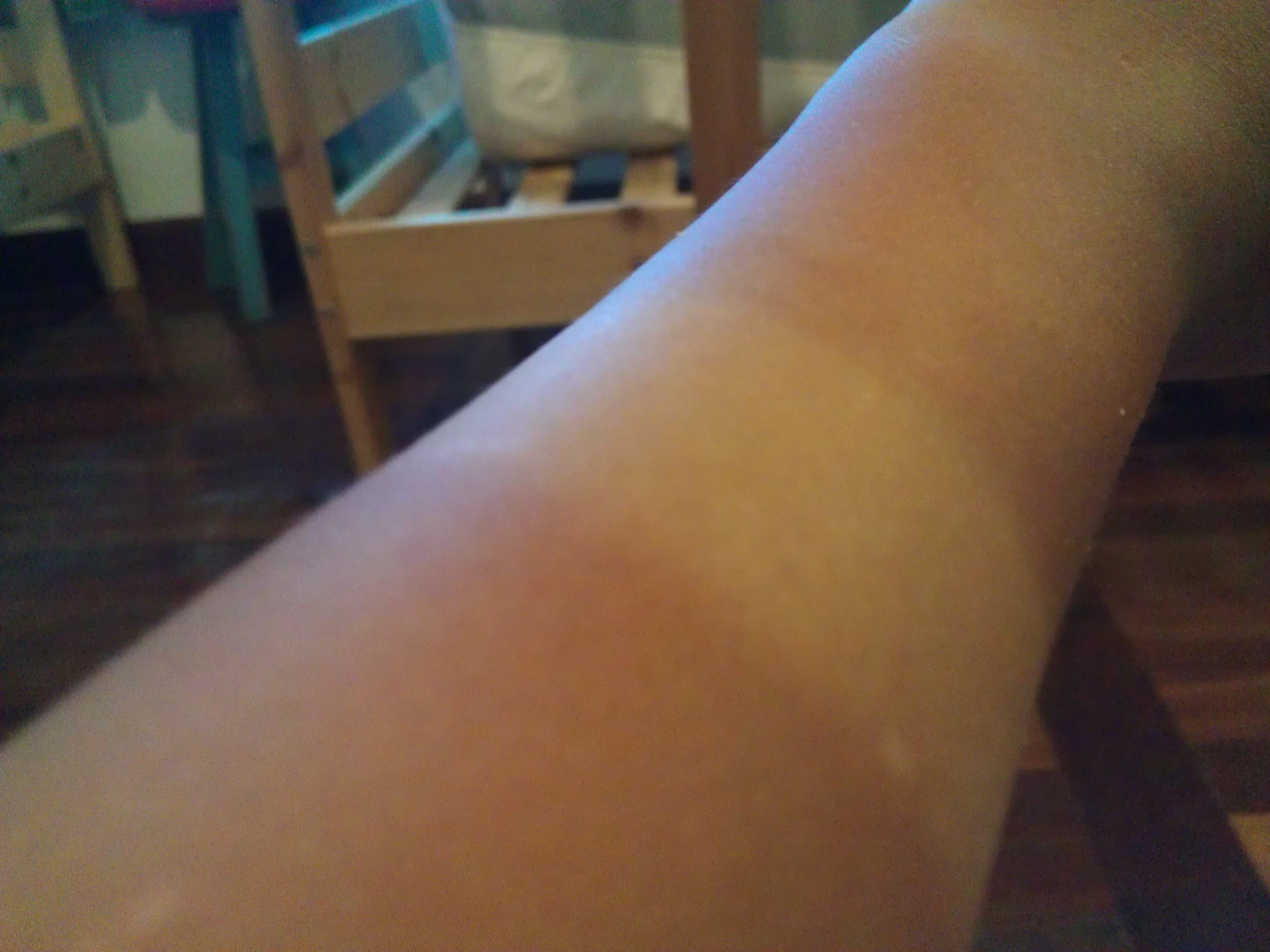 蚌埠點陣祛痘印醫(yī)生