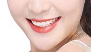 廈門電動負壓吸脂去雙下巴醫(yī)生