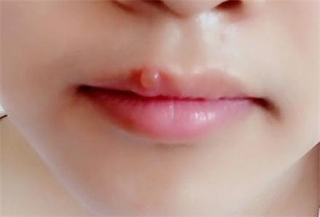 舟山面部溶脂針醫(yī)生