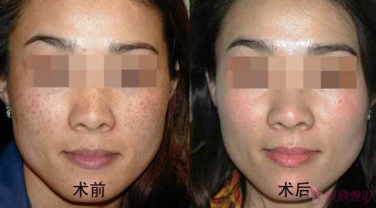 揭陽(yáng)自體脂肪填充豐唇醫(yī)生