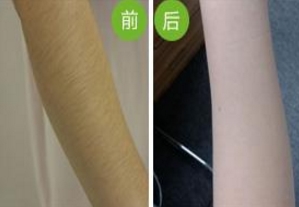 哪家南京雙眼皮手術醫(yī)院口碑好？2023年南京韓式雙眼皮手術前十名排序！