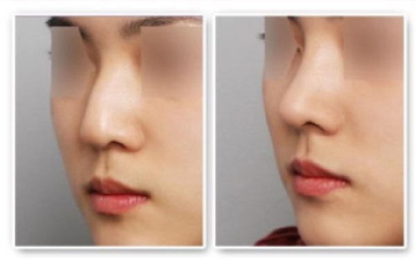 佛山地區(qū)鼻唇溝填充肉毒素醫(yī)療美容醫(yī)院推薦！2023年口碑比較好的整形醫(yī)院排名揭曉！