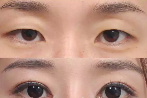 常德光纖溶脂減手臂醫(yī)生