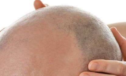 2023年十大口碑好的深圳水光針去眼底紋整形醫(yī)院揭秘！