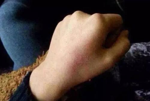 德陽去除頸部皺紋皺紋醫(yī)生