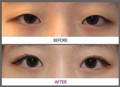 晉中激光除眉間紋醫(yī)生