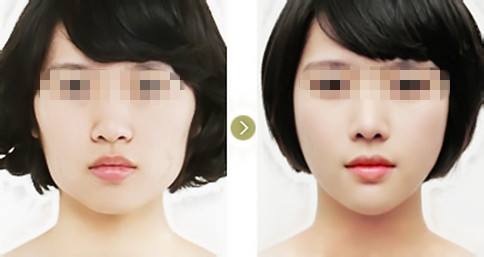 蕪湖射頻點陣激光痘坑醫(yī)生