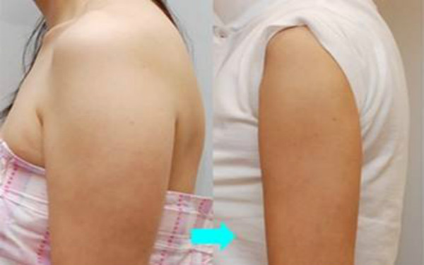 天津哪些整形美容醫(yī)院提供卓越的線雕去眼紋技術(shù)？2023比較推崇的天津線雕去眼紋前十佳整形醫(yī)院盤點！