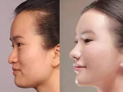 2023年，哪些上海自體脂肪面部精雕整形醫(yī)院的口碑特別好？排名榜前十值得信賴的美容整形醫(yī)院！