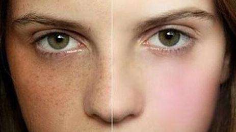 重慶針雕去除生長(zhǎng)紋醫(yī)生