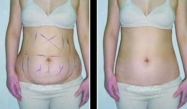 佛山非常受歡迎的雙眼皮納米手術(shù)醫(yī)院排行榜，詳細揭秘2023年前10名醫(yī)療整形機構(gòu)！