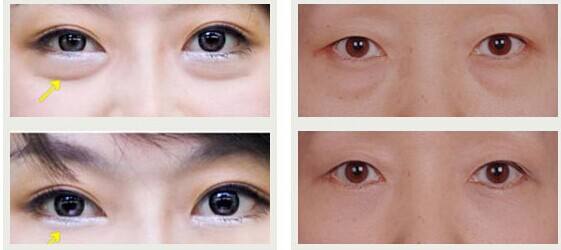 東莞有哪些效果好的川字紋除皺醫(yī)院？2023年東莞十大正規(guī)醫(yī)院排行榜出爐！