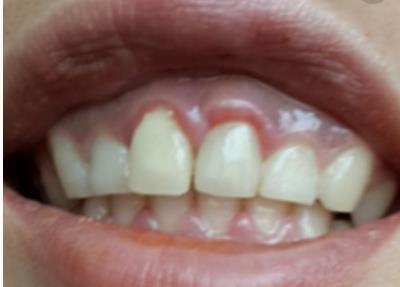 黃石哪家醫(yī)院能填充太陽穴假體？2023黃石太陽穴美容前十有哪些好選擇！