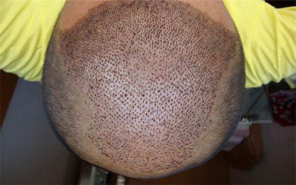 2023年比較好的中國(guó)光纖祛眼袋醫(yī)療整形醫(yī)院排名TOP10發(fā)布！哪家醫(yī)院做得比較好？