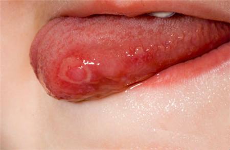 廈門微雕點(diǎn)陣去疤痕醫(yī)生